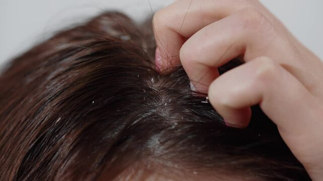 Young woman scratching her scalp, showing dandruff and irritated skin.