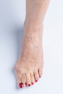 A silicone separator inserted between the big toe and index toe of a foot with hallux valgus