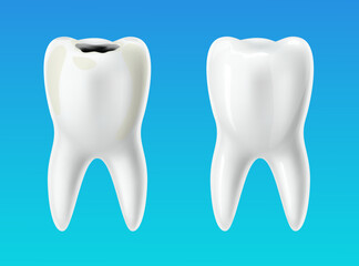 Healthy tooth and decayed tooth. 3D isolated teeth, caries professional treatment in stomatology, oral hygiene poster, before and after banner, dentistry advertising vector medical concept