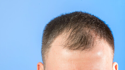 Fototapeta premium A man with a shaved head is looking at the camera. Concept of confidence and self-assurance, as the man's bald head is a symbol of his strength and independence