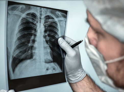 Tuberculosis. Disease Human lung cancer. Surgeon, Medical worker analyzes x-ray, radiographer carefully examines lung x-ray, doctor examines pneumonia, respiratory disease. Pulmonary complication