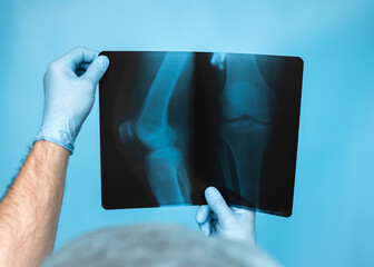 Diagnosis Human bone disease. Doctor traumatologist otoped analyzes a knee injury of a person's leg. X-rays of the doctor's knee are in his hands in the office. The doctor analyzes the damage leg