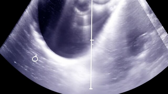 Ultrasound examination showing prostate gland