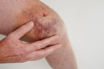 Fototapeta premium Knie nach Fahrradunfall, Hämatom in schillernden Farben am Kniegelenk, Bluterguss am Männerknie