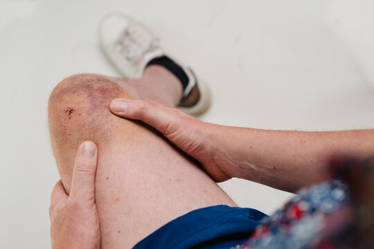 Knie nach Fahrradunfall, H&auml;matom in schillernden Farben am Kniegelenk, Bluterguss am M&auml;nnerknie