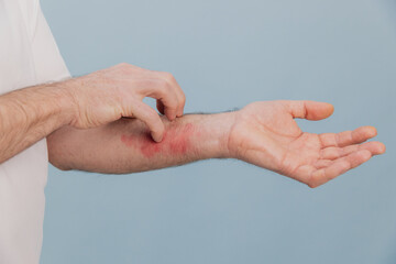 Male hand scratching itchy red rash on forearm skin