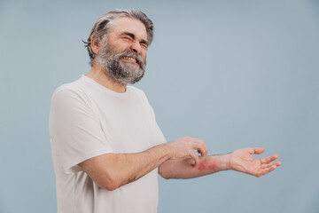 Senior man scratching itchy red rash on arm suffering from dermatitis