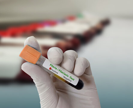 Doctor hold Blood sample for Lymphogranuloma Venereum (LGV) disease diagnosis test. HealthCare and medical concept.