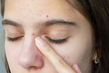 Close-up of acne on teenage skin. Close-up image of a young woman touching her face with visible acne, pimples, and skin blemishes, highlighting skincare issues.
