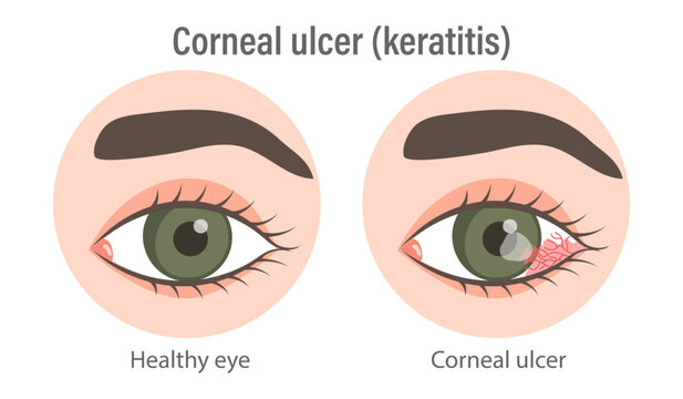 Illustration of corneal ulcer (keratitis). Healthy eye and eye with corneal ulcer. Medical infographic banner
