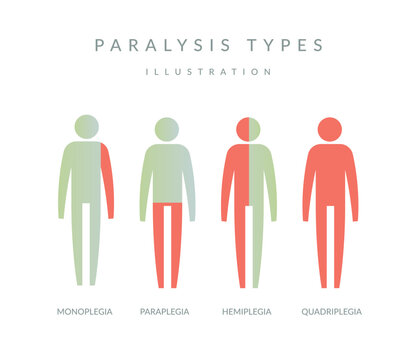 Types of Paralysis - Illustration