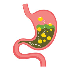 Human stomach vector illustration. Depicts gastritis, acid reflux, indigestion, heartburn, and stomach pain problems, illness, and unhealthy stomach.