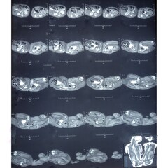 Conjoined twin girls MRI imaging. Conjoined buttock twins. Sacrum is deficient, fusion of both...