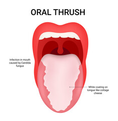 Diagram of Oral Trush Symptoms