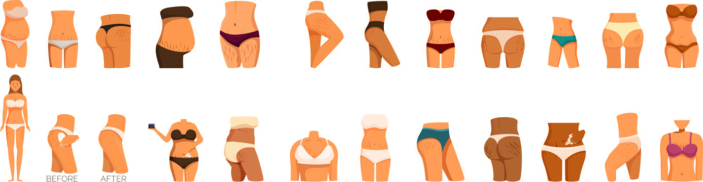 Stretch marks icons set. Female body positive and overweight problems, liposuction and cellulite removal concept
