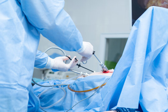 abdominal surgery, laparoscopy, cholecystectomy, removal of the gallbladder using an endoscope and laparoscope, hospital, operating room, patient under anesthesia, doctors