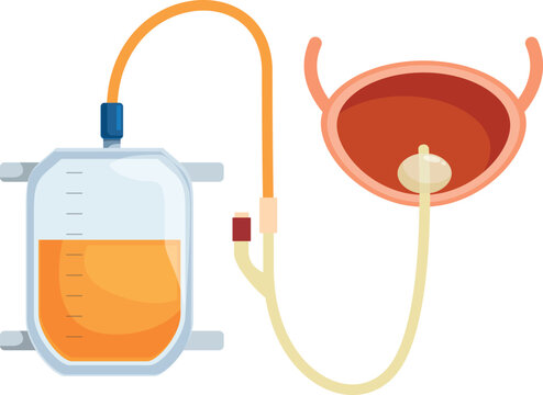 Medical illustration showing urinary catheter draining urine into collection bag, highlighting bladder function and catheterization process