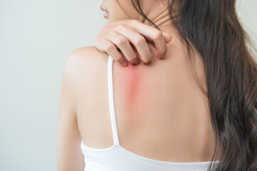 Dermatology, asian young woman, girl allergy, allergic reaction from atopic, insect bites on her...