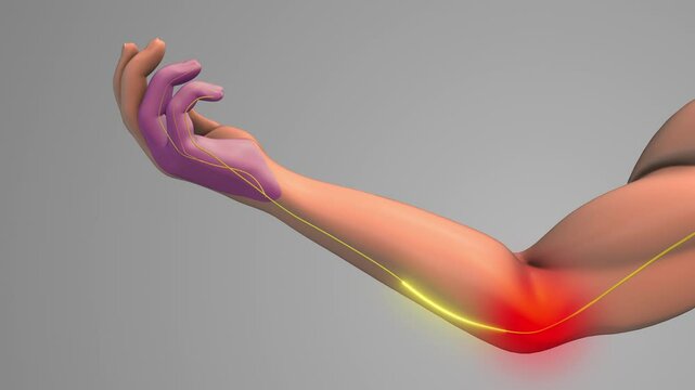 Cubital tunnel syndrome medical concept