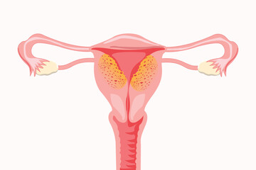 Anatomical illustration of the female reproductive system with symptoms of adenomyosis, with annotations. Vector medical illustration