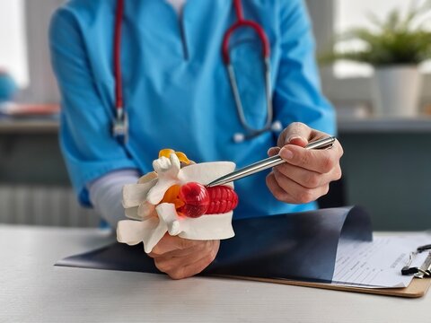 Intervertebral hernia treatment. Chiropractor with anatomical lumbar disc herniation model while consultation of man with back pain concept