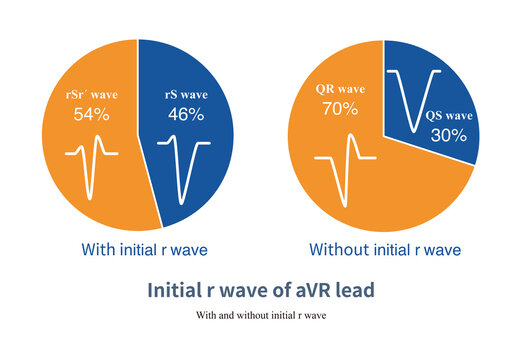 In the aVR lead, the QRS wave can have an initial r wave or no initial r wave, depending on whether the initial excitation is directed upwards or downwards.