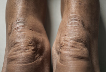Knees and wrinkled skin of the elderly
