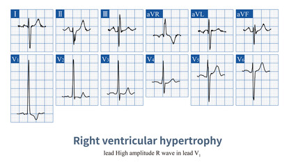 Female, 6 years old, clinically diagnosed with Tetralogy of Fallot. The electrocardiogram shows sinus rhythm, extreme right axis deviation, biatria abnormality, right ventricular hypertrophy, etc.