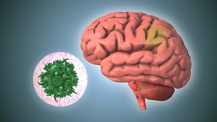 Guillain Barre Syndrome Affecting Nerves and Muscle Weakness