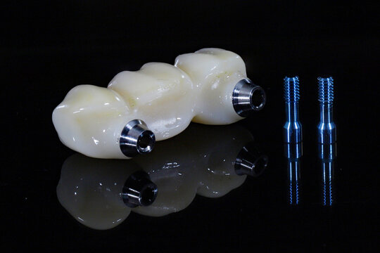 Dental implant surgery and dental implant supported bridge prosthesis. Screw retained treatment with porcelain crown restoration made of zirconium porcelain.
