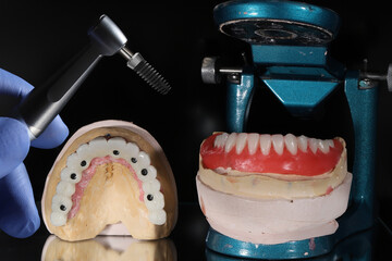 Dental implant surgery and dental implant supported bridge prosthesis. Screw retained treatment with porcelain crown restoration made of zirconium porcelain.
