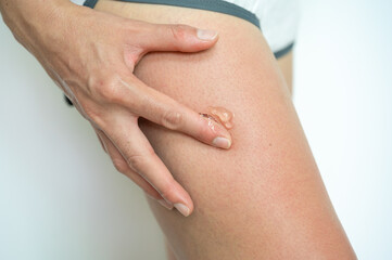 Close up of woman applying Aloe vera gel on her thigh for solving sunburn damaged.