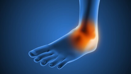 Fototapeta premium The anatomy of a sprained ankle