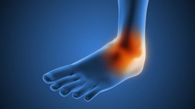 The anatomy of a sprained ankle