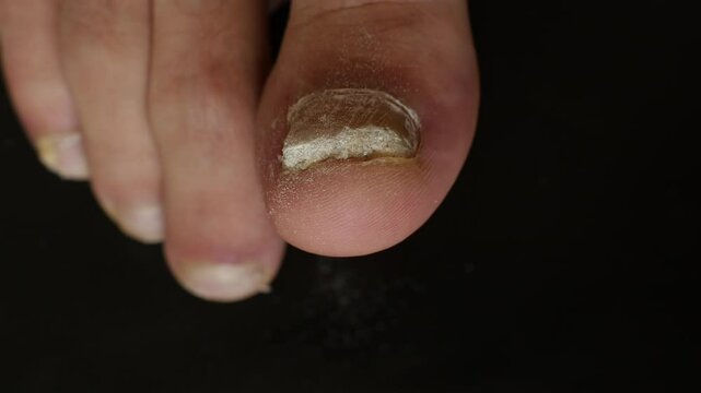 Close-up of a big toe with severe fungal infection and thick nail on black background