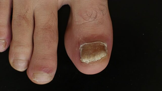 Detailed view of a big toe with a thick fungal nail infection on a black clinical backdrop
