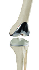 Total Knee Replacement is surgery to replace diseased or damaged joint surfaces of the knee with metal and plastic prosthetic devices.