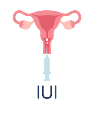 Intrauterine insemination infographic. IUI poster. Uterus and syringe with sperm illustration in cartoon flat style