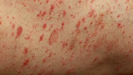 Fototapeta premium Close up of pityriasis rosea rash on caucasian skin thought to be an immune response after an upper respiratory infection