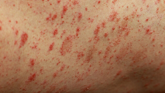 Close up of pityriasis rosea rash on caucasian skin thought to be an immune response after an upper respiratory infection