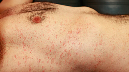 Fototapeta premium Macular red patches on a caucasian male chest, distinctive of a measles or rubeola rash 
