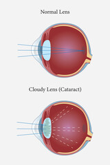 illustration of cataract in human eyes. eye vision disorder. vector illustration. medical illustration