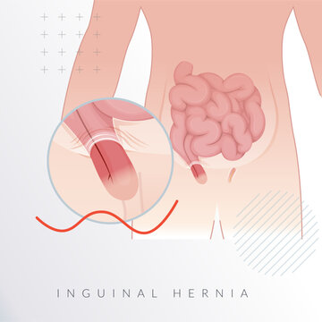 Strangulated Inguinal Hernia-  Section of the Intestines - Stock Illustration