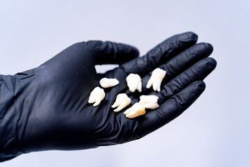 Dental extractions displayed on a hand. A gloved hand holds several extracted teeth against a...