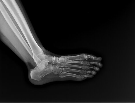 human foot ankel and leg xray picture