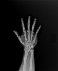 x-ray of the hand and wrist bones