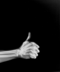 Film xray x-ray or radiograph of a thumb up associated with agreement, approval, confirmation or positivity in gestural language, manual