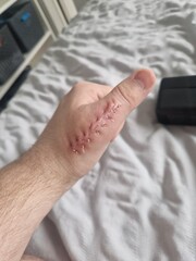 Thumb surgery