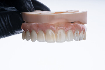 Full dental zirkonium prosthesis on titanium bar stained with stains for ceramic