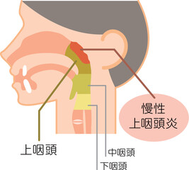 慢性上咽頭炎の説明図・カラー・図解_イラスト